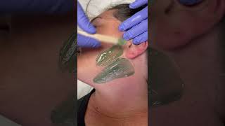 Professional chin wax using hard wax [upl. by Ioves]