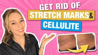 How to Get Rid of Stretch Marks amp Cellulite from a Dermatologist  Dr Shereene Idriss [upl. by Ala61]