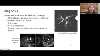 Webinar Biliary stent and drain management for patients with cholangiocarcinoma [upl. by Tower]