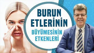 BURUN ETLERİNİN BÜYÜMESİNİN ETKENLERİ [upl. by Ritchie616]