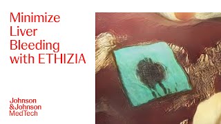 How to Use ETHIZIA Hemostatic Sealing Patch To Control Superficial Bleeding of Liver  JampJ MedTech [upl. by Aroled]