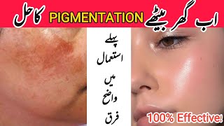 Best Remedy for Hyperpigmentation and Dark Spots  Homemade Pigmentation Solution Treatment Mask [upl. by Zoara]