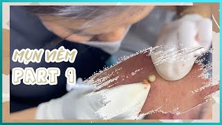 Big Cystic Acne Blackheads Extraction Blackheads amp Milia Whiteheads Removal Pimple Popping [upl. by Pugh]