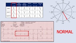 Cardiac Axis Determination [upl. by Yeliw]