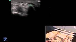 3D How To Ultrasound Exam of the Guyons Canal  SonoSite Ultrasound [upl. by Libbna]