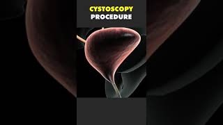 CYSTOSCOPY PROCEDURE [upl. by Boggers]