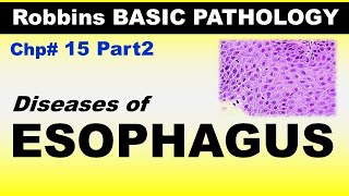 Chp15 Part2 Robbins Basic Patho  Diseases of ESOPHAGUS  Dr Asif Lectures [upl. by Acsecnarf373]