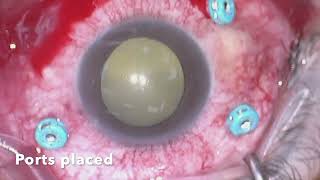 Endophthalmitis Vitrectomy [upl. by Ainod]