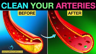 How to Unclog Your Arteries Naturally and Prevent Heart Attack  Dr Ghulam Wellness [upl. by Norina5]