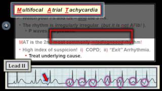 ECG Video6 Blog 100 Rhythm MgmtPart 3 111212014 [upl. by Leval]