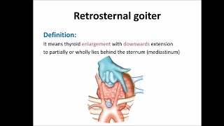 Retrosternal goiter [upl. by Iblok719]