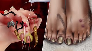 ASMR Treatment  Animated fingernail and toenail removal treatment according to ASMR standards [upl. by Nichols]