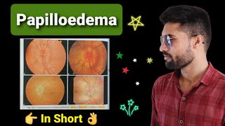 Papilloedema lecture opthalmology [upl. by Ondrej851]