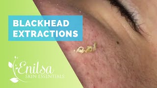 Blackheads Extractions and Acne Treatment on Daryl [upl. by Mart451]