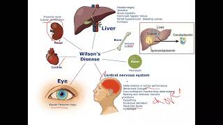 pediatric Hepatology Wilsons Disease [upl. by Encratis]