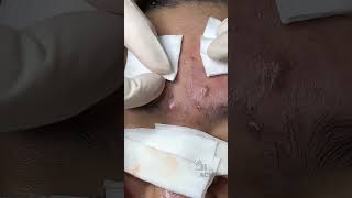 Inflamed Acne and Blackhead Removal CloseUp [upl. by Leamse242]