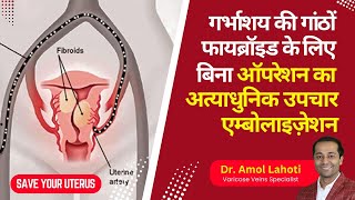 Uterine Artery Embolization UAE Explained amp Live Surgery by Dr Amol Lahoti [upl. by Ydarg]