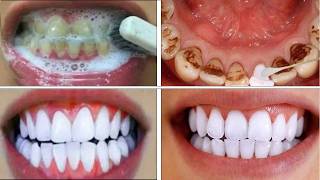 Remove Black Stains on Teeth at Home in 3 Minutes  Natural Teeth Whitening Method [upl. by Shayne761]