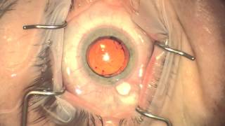 Toric IOL Rotation in patient with Residual Astigmatism [upl. by Giulia128]