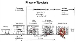 Cancer Progression  Hallmarks Hyperplasia Carcinoma in situ Invasive Carcinoma amp Metastasis [upl. by Birdt]
