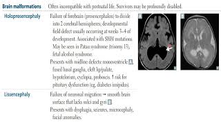 USMLE STEP 1  Neurology  Neural defects Brain malformation [upl. by Neelia497]