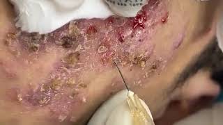 BEST BLACKHEAD AND WHITEHEAD REMOVAL SEVERE ACNE TREATMENT  SATISFYING AND RELAXING VIDEO [upl. by Arde]