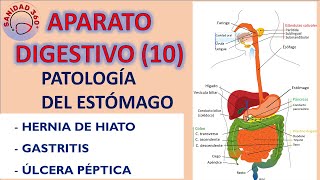 10 APARATO DIGESTIVO  Patología del estómago [upl. by Enyehc]