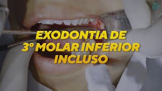 EXODONTIA DE TERCEIRO MOLAR INCLUSO  CIRURGIA [upl. by Ennaisoj]