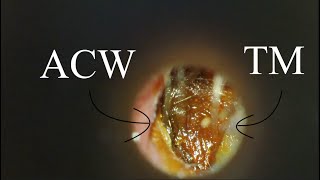 DEEP IMPACTION  ANTERIOR SULCUS  4KHD [upl. by Zoller799]