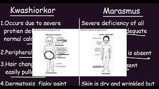 Kwashiorkor vs Marasmus Quick Differences amp Comparison [upl. by Han]