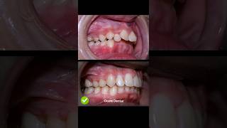 Braces overbite treatment braces orthodontist dentist dental [upl. by Casady]