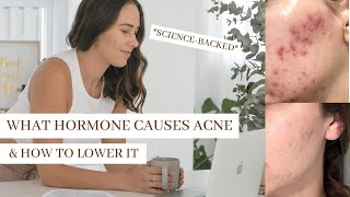 What Hormone Causes Acne PUT AN END TO HORMONAL ACNE [upl. by Irahcaz]