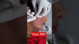 PRP Treatment for face shortsvideo [upl. by Noived]