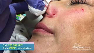 Facial Vein Removal Using Radio Frequency  Reno Sparks MedSpa  Dr Calvin Van Reken [upl. by Schlessel]