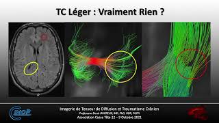 IRM de Tenseur de Diffusion et Trauma Crânien  Etat de lArt et Perspectives [upl. by Vanessa]