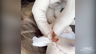 Extracting a Pilar Cyst Pilar Cysts Can Haunt Your Scalp  CONTOUR DERMATOLOGY [upl. by Collie]