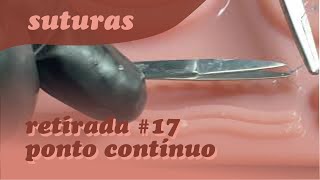 SUTURA  RETIRADA DE PONTO CONTÍNUO 17 [upl. by Iridissa]