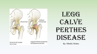 Perthes disease  clinical features investigation Waldenstrom staging Herring classification [upl. by Byrle874]