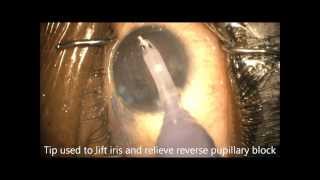 How to Beat Reverse Pupillary Block During Phaco Chris Teng MD [upl. by Tyika]