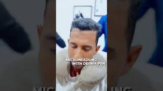 The Shocking Before amp After of Trichometric Hair PRP caraclinic beforeandafter hairrestoration [upl. by Ydnat]