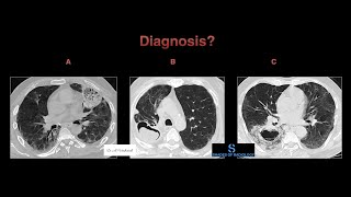 3 Classic signs of Fungal infections in chest [upl. by Jeddy540]