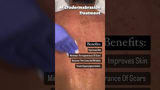 What Is Microdermabrasion  Back Treatment [upl. by Enilkcaj]