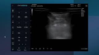 Ultrasound guided supraclavicular and axillary brachial plexus blocks [upl. by Caffrey]