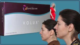 Chin And Jawline Filler Juvederm VOLUX With Before And After Pictures [upl. by Hsot]