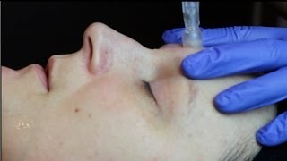 DermaStamp Treatment [upl. by Akirahs]