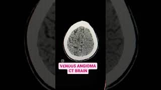 Venous Angioma CT Brain Explained [upl. by Niryt]