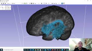 The anatomy of the arcuate fasciculus using diffusion MRI data [upl. by Dopp]