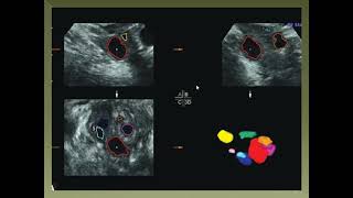 Antral follicle count [upl. by Hsevahb]