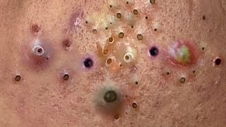 blackheads new 2023  popping pimple  acne and whiteheads removal [upl. by Shanleigh]