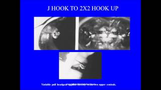 j hook headgear  orthodontic courses by Indian dental academy [upl. by Desireah]